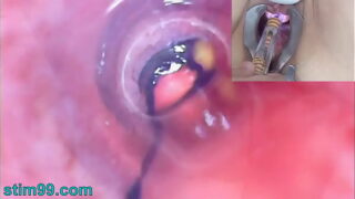 Endoscope